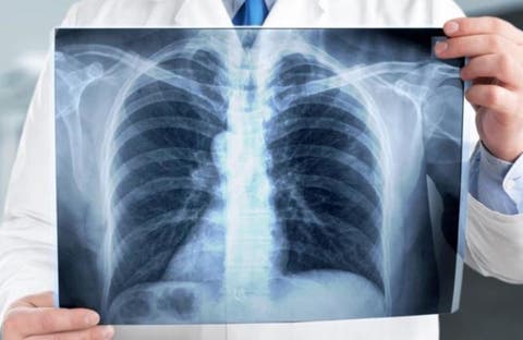 تسجيل 30 ألفا و355 حالة تخضع للعلاج من داء السل بالمغرب