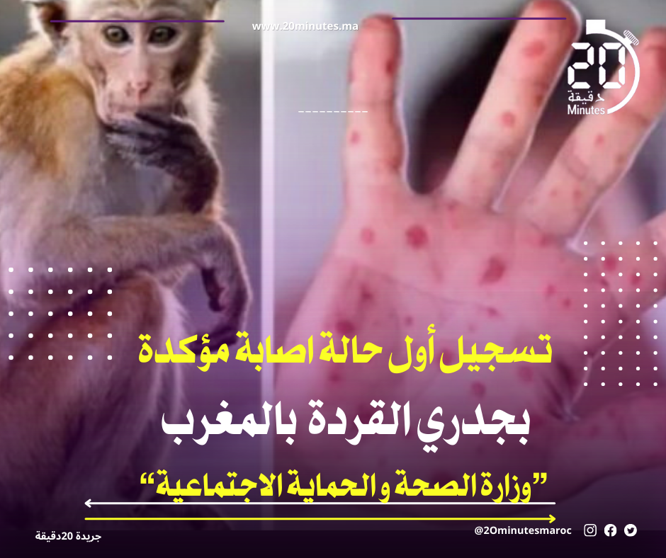 المغرب يعلن عن تسجيل أول حالة اصابة مؤكدة بجدري القردة