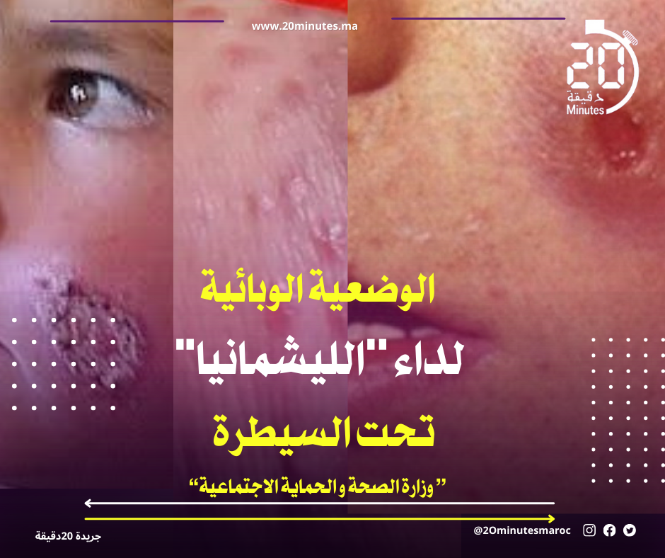 الوضعية الوبائية بخصوص داء ”الليشمانيا” تحت السيطرة