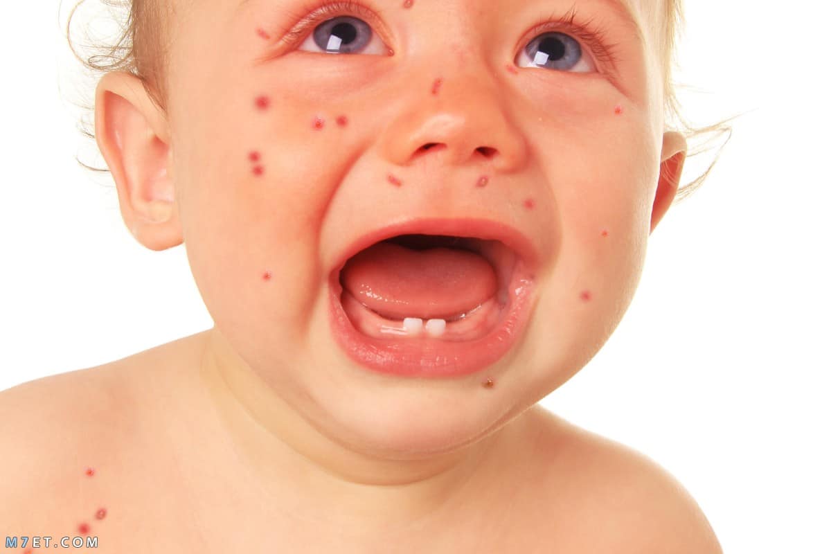 التلقيح أولوية لمكافحة الحصبة..الحكومة تدعو لمواجهة المعلومات المضللة